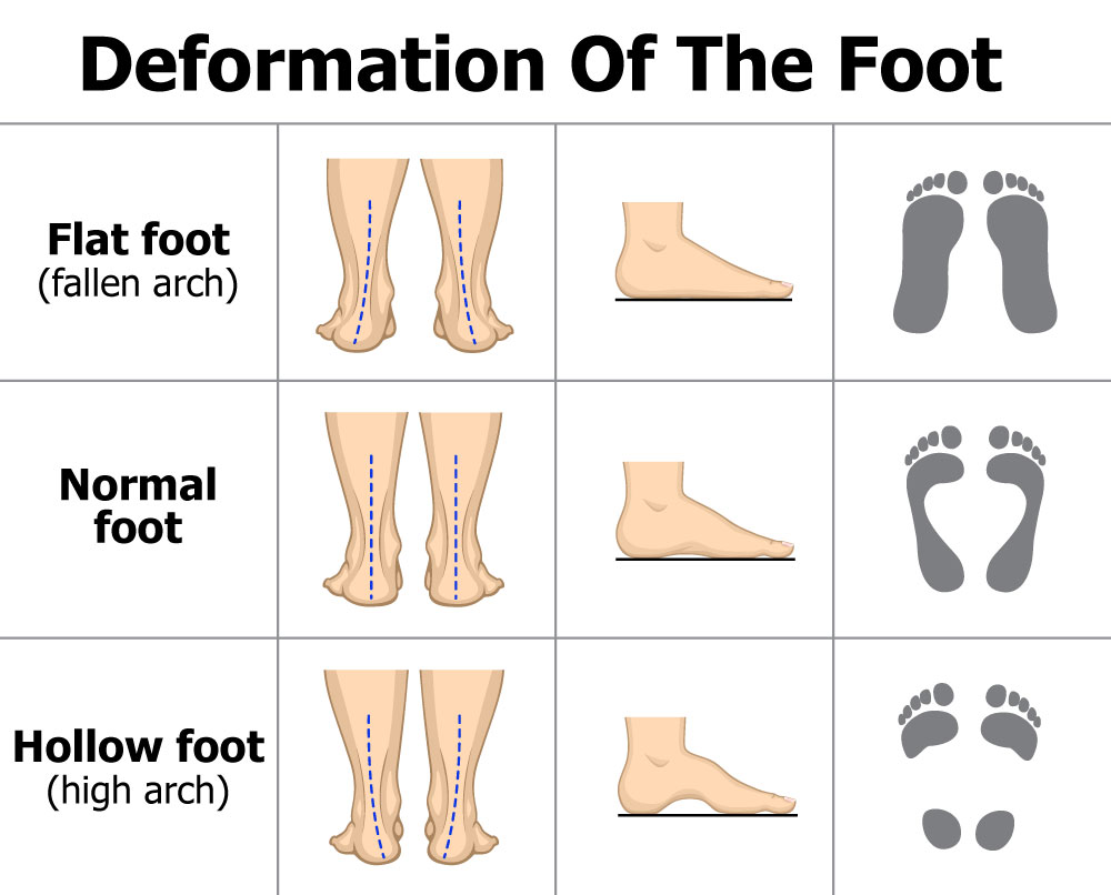 Deformation Of The Foot Diagram