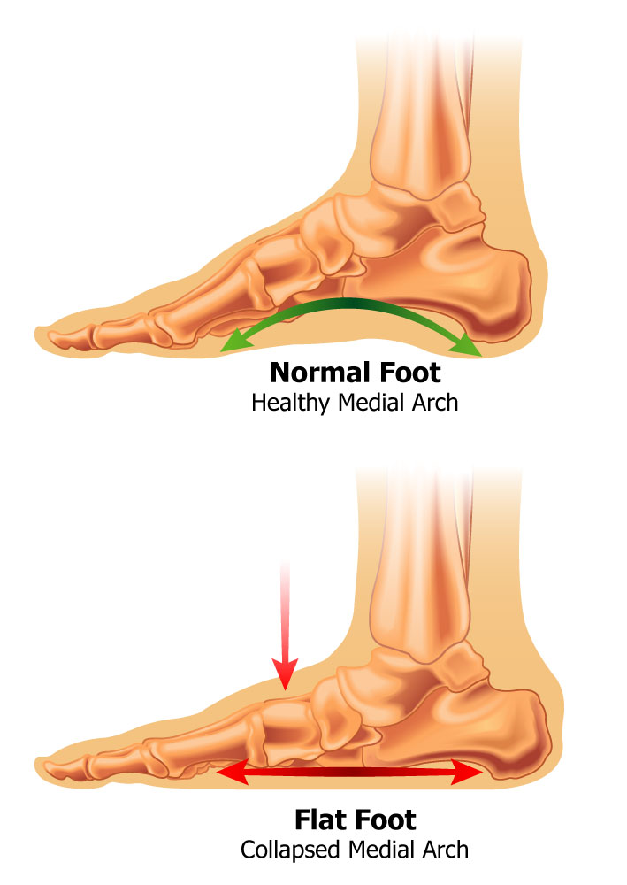 Normal Foot Arch & Flat Foot Arch