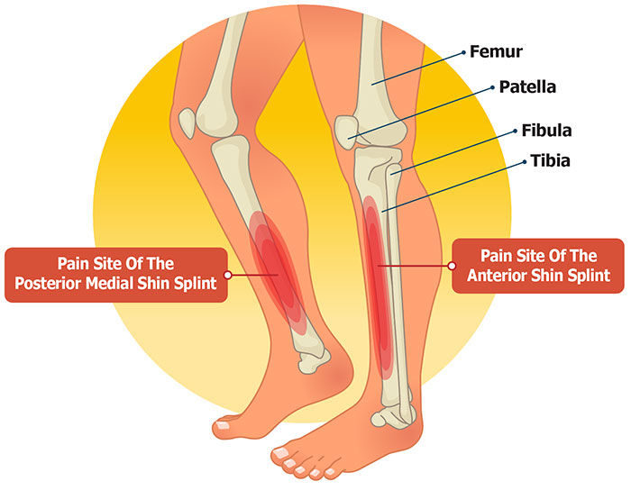 Shin Splints Diagram