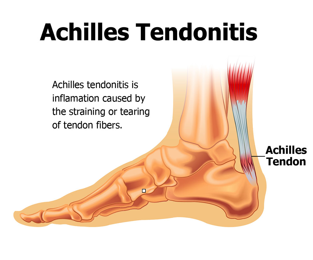 Achilles Tendonitis Diagram