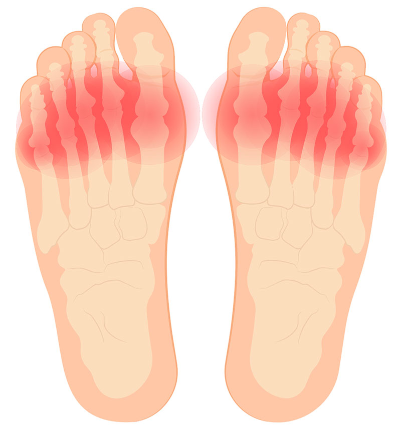 Diagram of ball of foot pain area